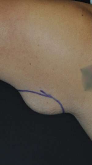 Minimal Incision and Power-assisted Liposuction Removal of Lipomas