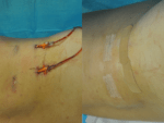 Minimal Incision and Power-assisted Liposuction Removal of Lipomas