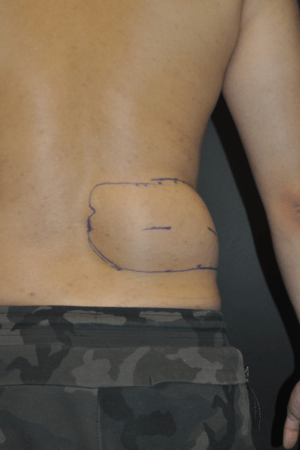 Minimal Incision and Power-assisted Liposuction Removal of Lipomas