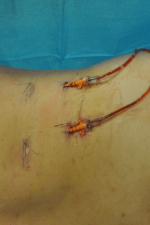 Minimal Incision and Power-assisted Liposuction Removal of Lipomas