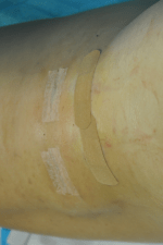 Minimal Incision and Power-assisted Liposuction Removal of Lipomas