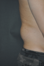 Minimal Incision and Power-assisted Liposuction Removal of Lipomas