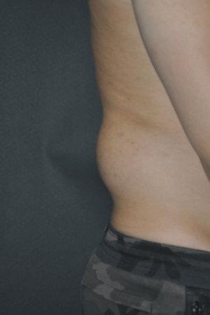 Minimal Incision and Power-assisted Liposuction Removal of Lipomas