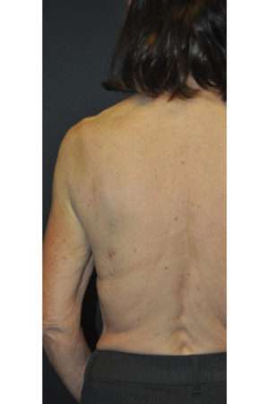 Minimal Incision and Power-assisted Liposuction Removal of Lipomas