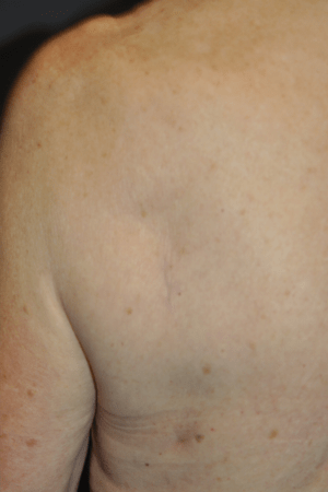 Minimal Incision and Power-assisted Liposuction Removal of Lipomas