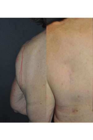 Minimal Incision and Power-assisted Liposuction Removal of Lipomas