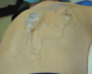 Minimal Incision and Power-assisted Liposuction Removal of Lipomas