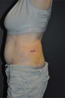 Minimal Incision and Power-assisted Liposuction Removal of Lipomas