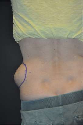 Minimal Incision and Power-assisted Liposuction Removal of Lipomas