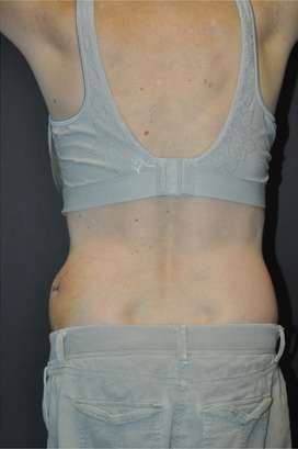 Minimal Incision and Power-assisted Liposuction Removal of Lipomas