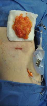 Minimal Incision and Power-assisted Liposuction Removal of Lipomas