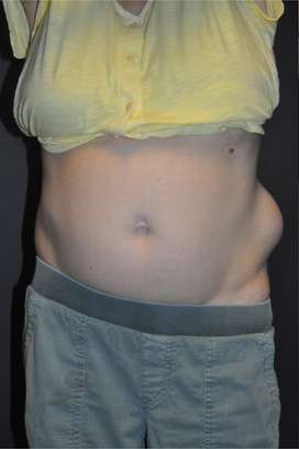 Minimal Incision and Power-assisted Liposuction Removal of Lipomas