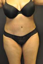 Abdominoplasty