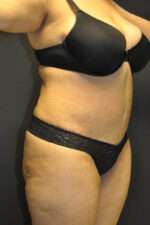 Abdominoplasty