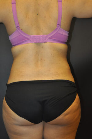 Abdominoplasty