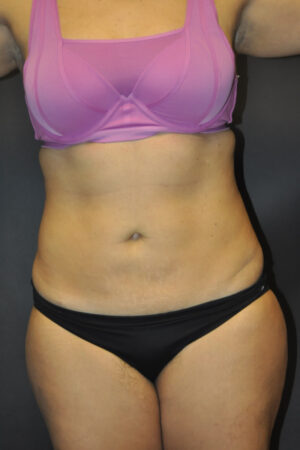 Abdominoplasty