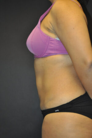 Abdominoplasty