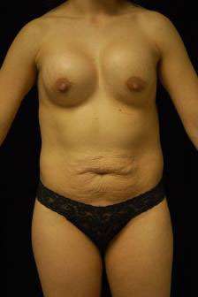 Liposuction Before