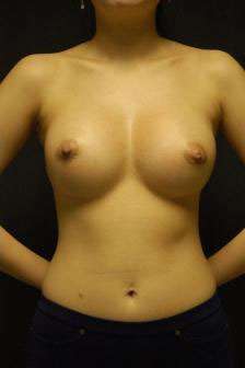 Breast Augmentation After