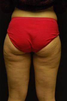 Liposuction Before