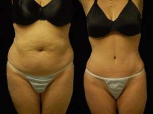 Abdominoplasty Results Mountain View