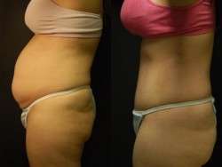 Tummy Tuck Results 5 weeks