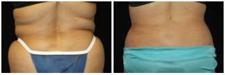 Patient before and after SmartLipo Triplex™ for fat reduction