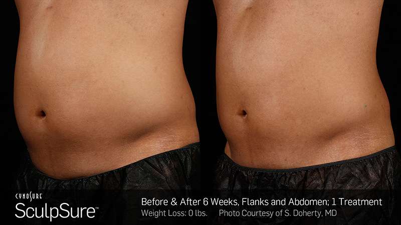 How to Choose Between Liposuction and Noninvasive Fat Reduction Procedures  - ABCS