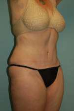 Drainless Tummy Tuck Mountain View Results