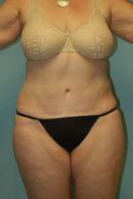 Drainless Tummy Tuck Mountain View Results