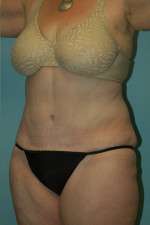 Drainless Tummy Tuck Mountain View Results