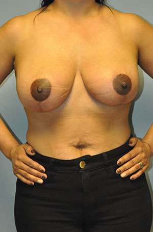 Breast Lift Result Mountain View