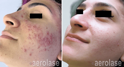 Acne Before and After