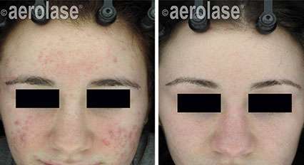 NeoClear Before and After