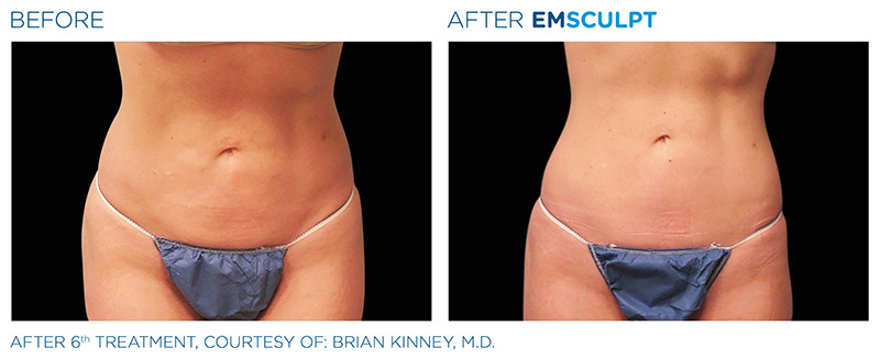 EmSculpt Female Abdomen Before & After