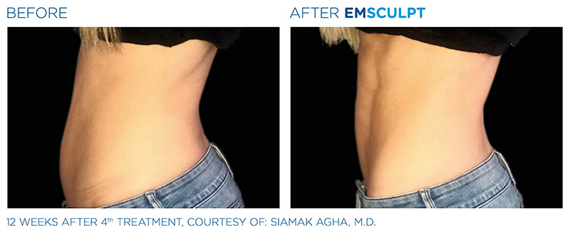 EmSculpt Female Abdomen Before & After