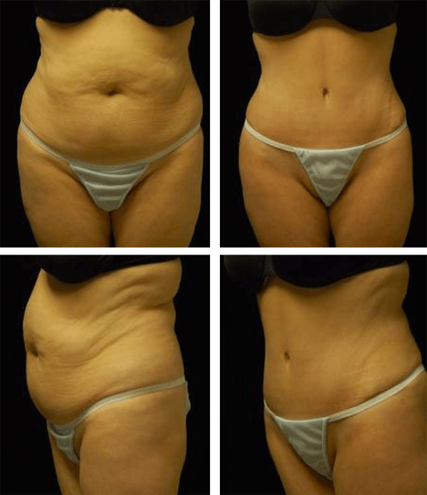 Before & After Photos of Dr. Lowen's Patients