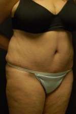 Abdominoplasty