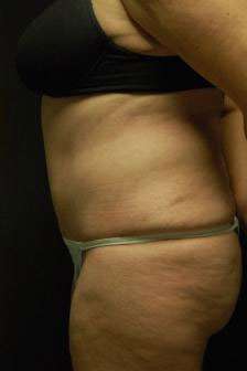 Abdominoplasty