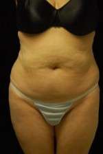 Abdominoplasty