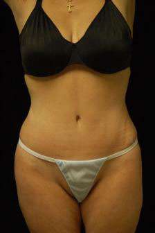 Abdominoplasty