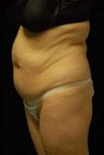 Abdominoplasty