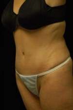 Abdominoplasty