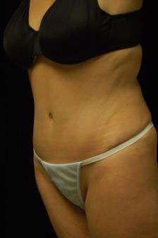 Abdominoplasty