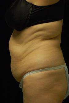 Abdominoplasty