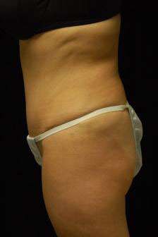 Abdominoplasty