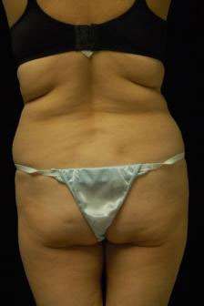 Abdominoplasty