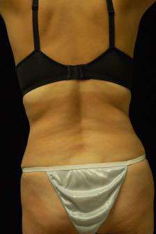 Abdominoplasty