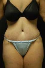 Abdominoplasty