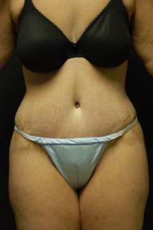 Abdominoplasty